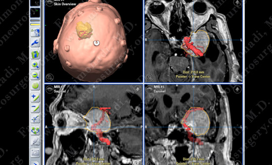 Meningioma Case 19 Image 3