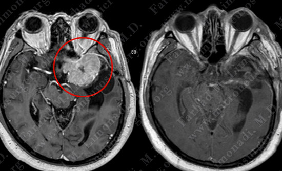 Meningioma Case 19 Image 4