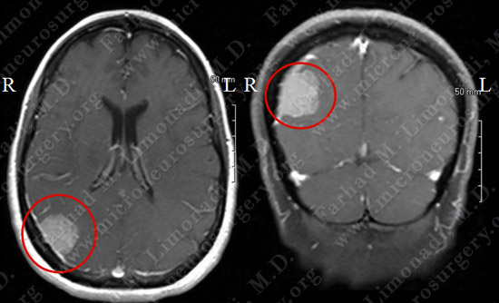 Meningioma Case 20 Image 1