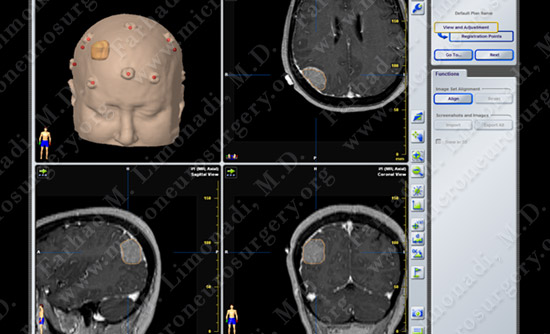 Meningioma Case 20 Image 2