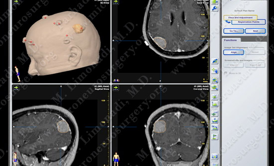 Meningioma Case 20 Image 3