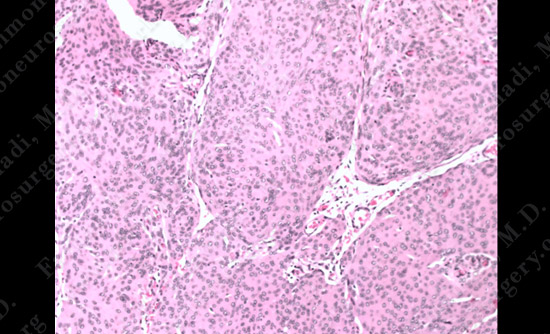 Meningioma Case 20 Image 4