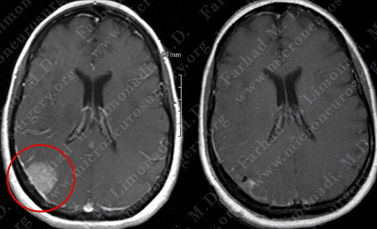 Meningioma Case 20 Image 5