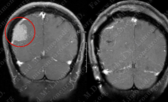 Meningioma Case 20 Image 6