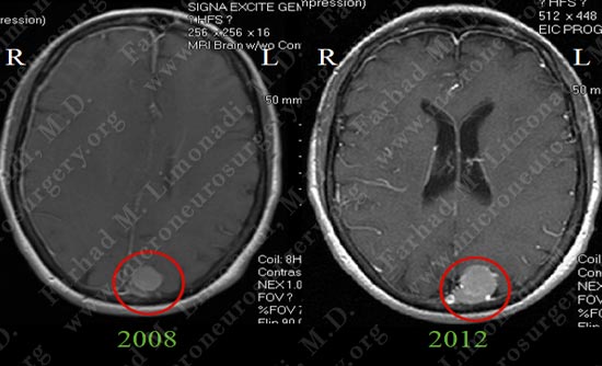 meningioma-case19-001