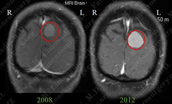 meningioma-case19-002