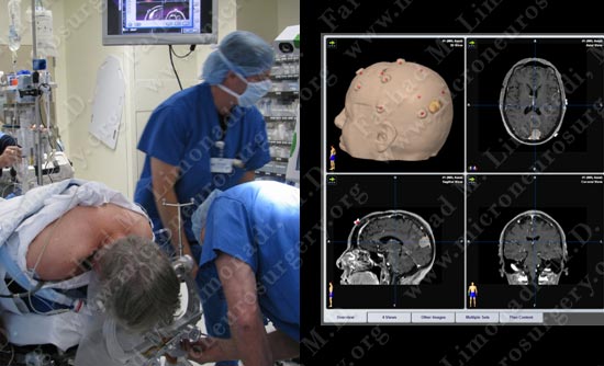 meningioma-case19-003