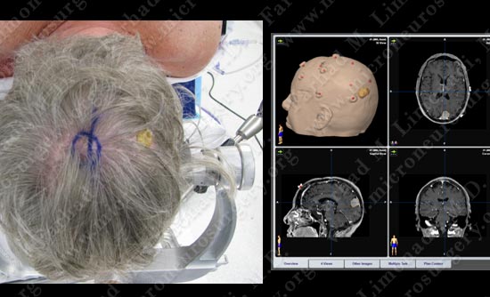 meningioma-case19-004