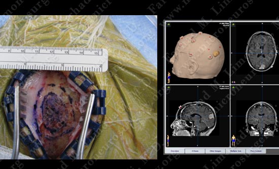 meningioma-case19-005