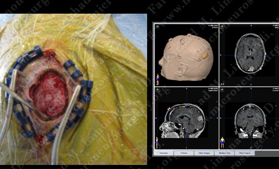 meningioma-case19-006