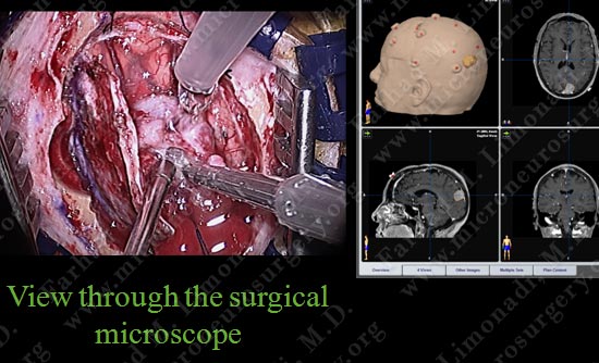 meningioma-case19-007