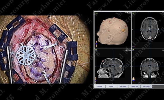 meningioma-case19-008