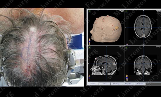 meningioma-case19-009