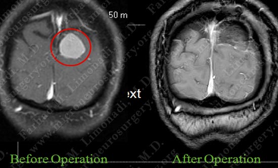 meningioma-case19-010