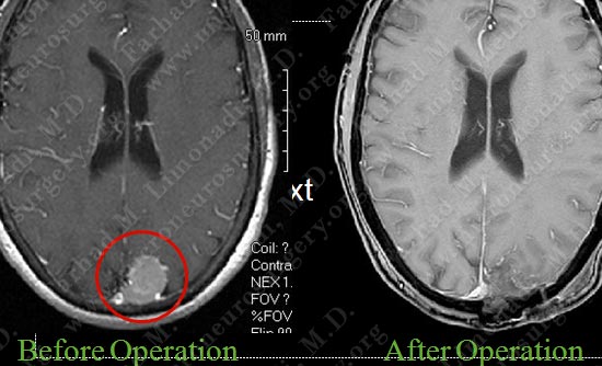 meningioma-case19-011