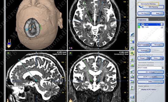 Parkinsons-case2-001