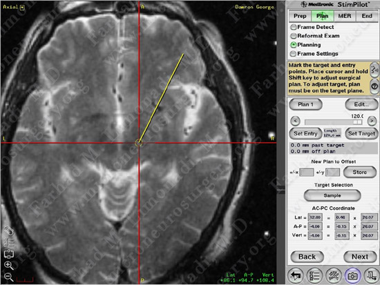 Parkinson's Disease Case 1 Image 13