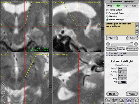 Parkinson's Disease Case 1 Image 14