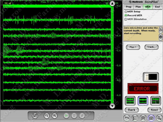 Parkinson's Disease Case 1 Image 18