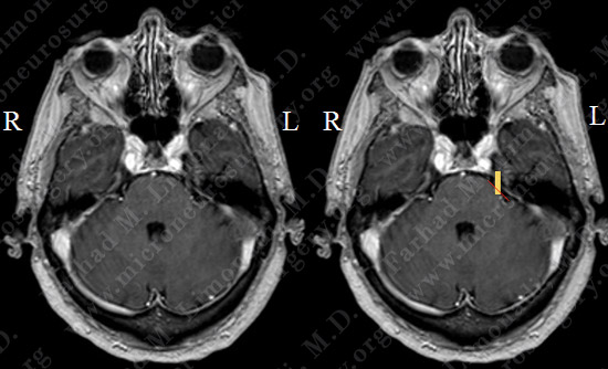 trigeminal case3 img1