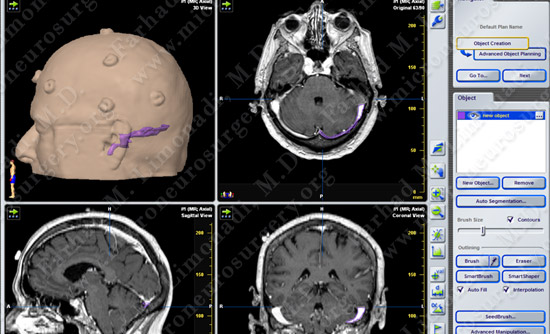 trigeminal case3 img2