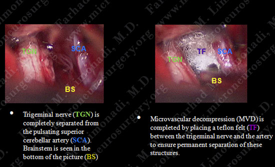 trigeminal case3 img4